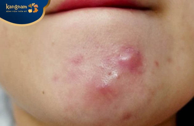 Mụn ở dạng cục