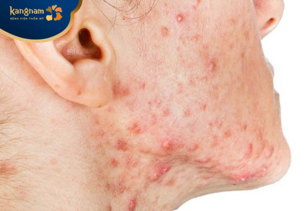 Mụn ở dạng nang