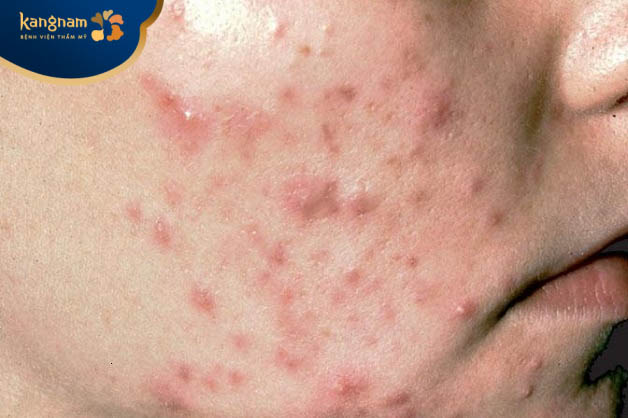 Mụn trứng cá hình thành gây sưng đau