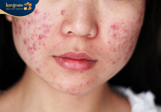 Thiếu hụt vitamin D khiến da không đủ đề kháng trước vi khuẩn