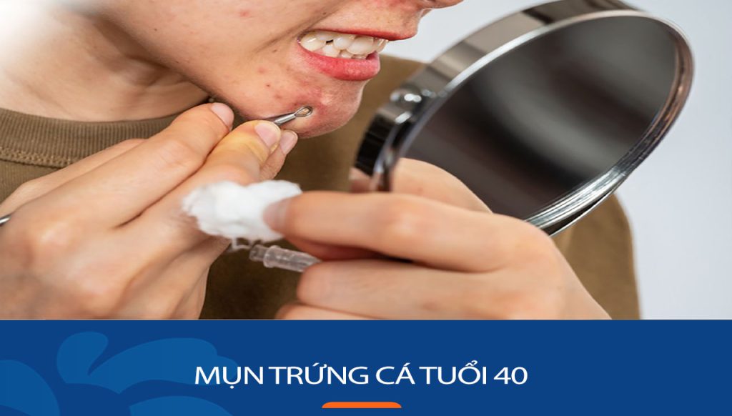 Giải pháp điều trị mụn trứng cá hiệu quả cho người phụ nữ tuổi 40