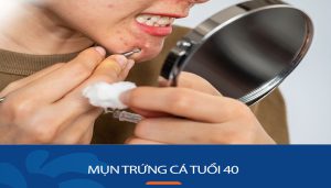 Giải pháp điều trị mụn trứng cá hiệu quả cho người phụ nữ tuổi 40