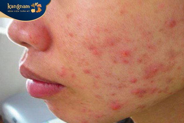 Mụn viêm không nhân