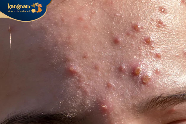 Mụn viêm có đặc điểm sưng tấy đỏ, gây cảm giác đau khi chạm vào