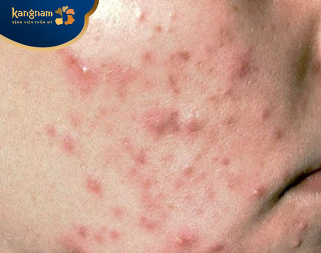 Mụn bị viêm kèm theo biểu hiện sưng đỏ có nguy hiểm không?