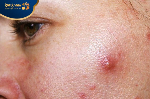 Triệu chứng sưng đỏ của mụn bị viêm 