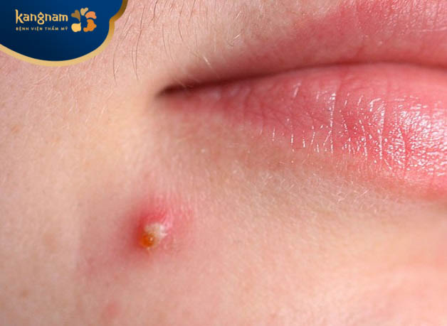 Có xuất hiện mủ bên trong nhân mụn 