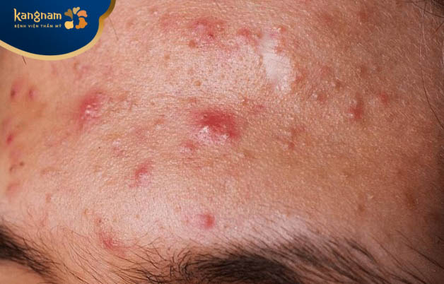 Mụn viêm sưng đỏ là gì? 
