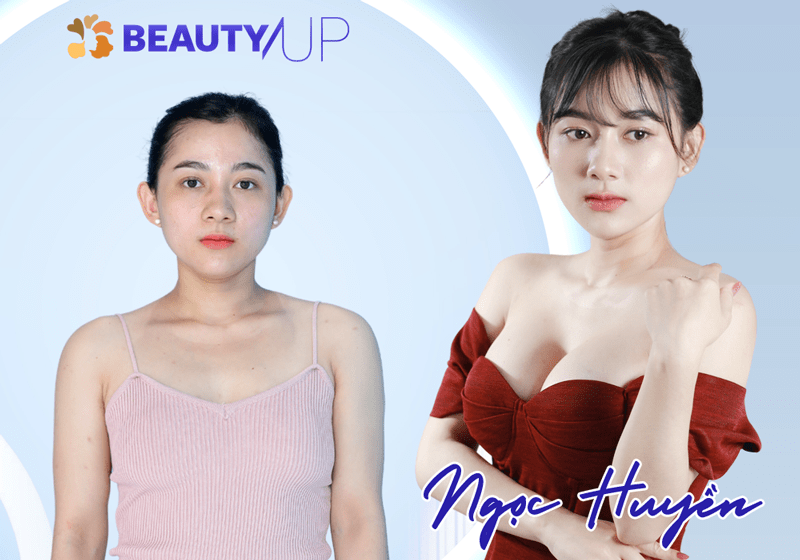 Kết quả nâng ngực 6D không chạm của Ngọc Huyền