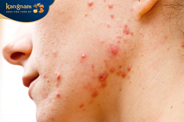 Có nhiều nguyên nhân gây mụn nang