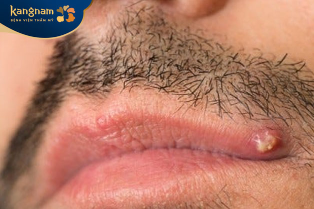 tiếp xúc với vi khuẩn làm nhiễm trùng da