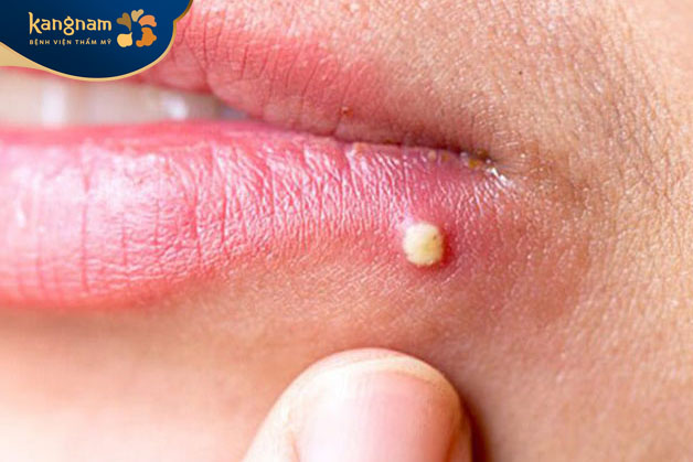 nguyên nhân chính là do tắc nghẽn lỗ chân lông