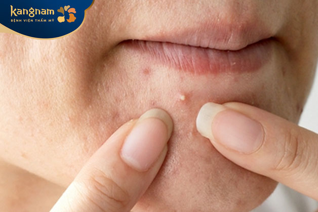 không có cảm giác đau nhức khi chạm vào mụn