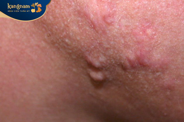 Thay đổi nội tiết tố gây mụn viêm sưng cục