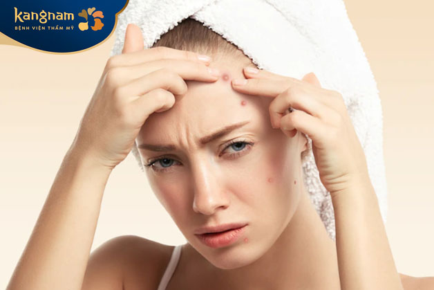 Thời điểm nặn mụn là yếu tố quan trọng