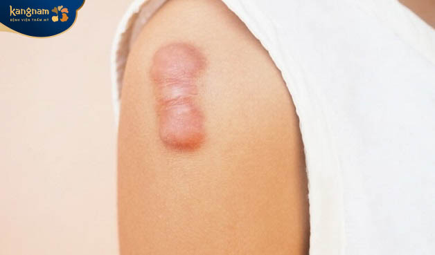 Sẹo lồi màu đỏ hình thành do nhiều nguyên nhân 