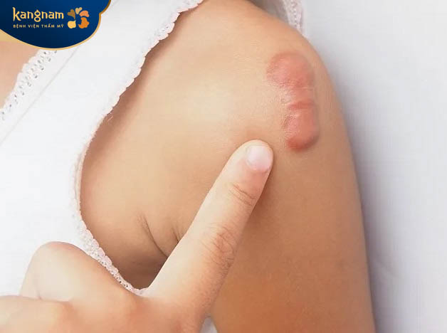 Sẹo lồi không thể tự khỏi được