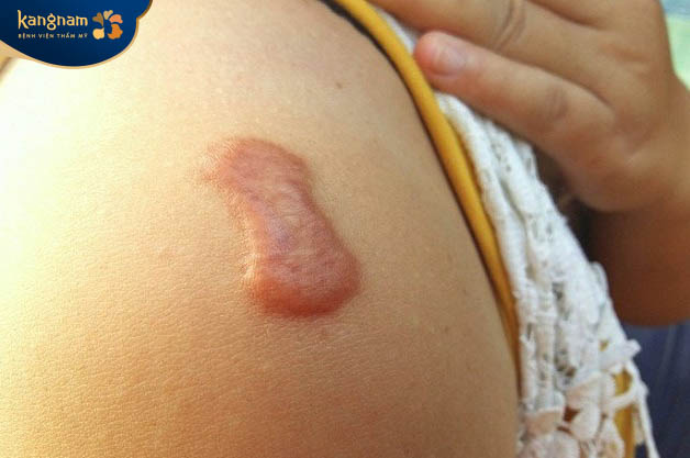 Tình trạng sẹo lồi đỏ 