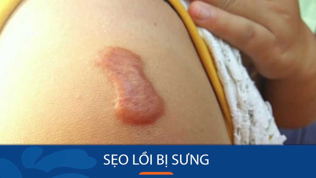 Sẹo lồi bị sưng: Nên làm gì và không nên làm gì?