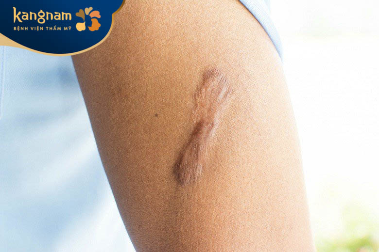 Tình trạng sưng tấy vết sẹo lồi có thể được chỉ định phẫu thuật hoặc xạ trị