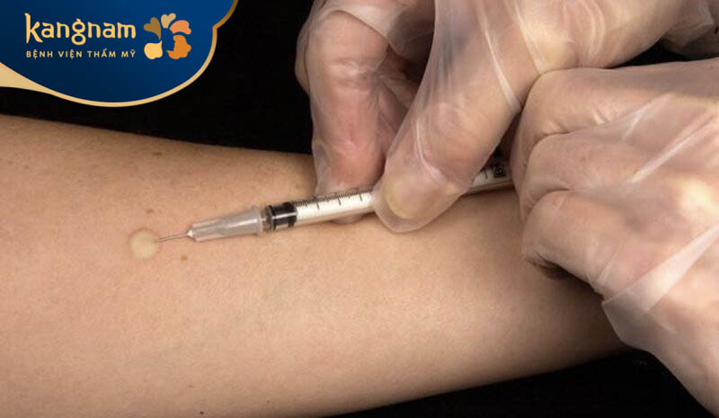 Tiêm thuốc để điều trị sưng tấy sẹo lồi