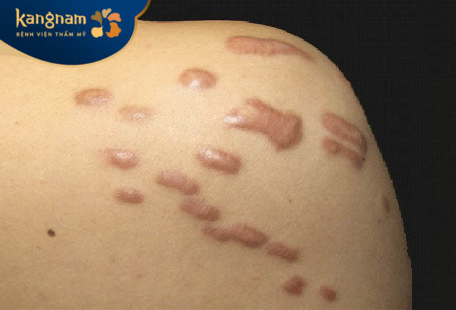 Sẹo lồi sưng tấy vài ngày thường không gây nguy hiểm