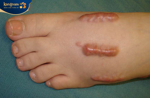 Thời điểm trị sẹo thích hợp nhất là cuối giai đoạn tăng sinh và giai đoạn đầu tái tạo da