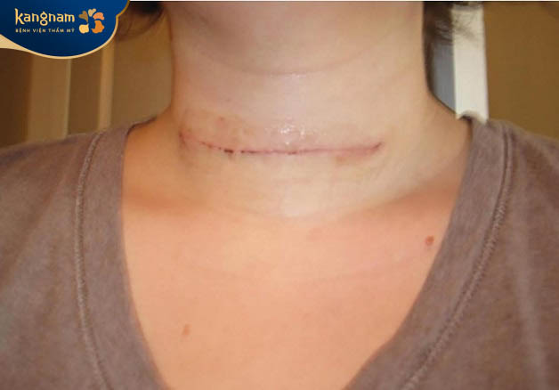 Sẹo lồi ở cổ do mổ u tuyến giáp