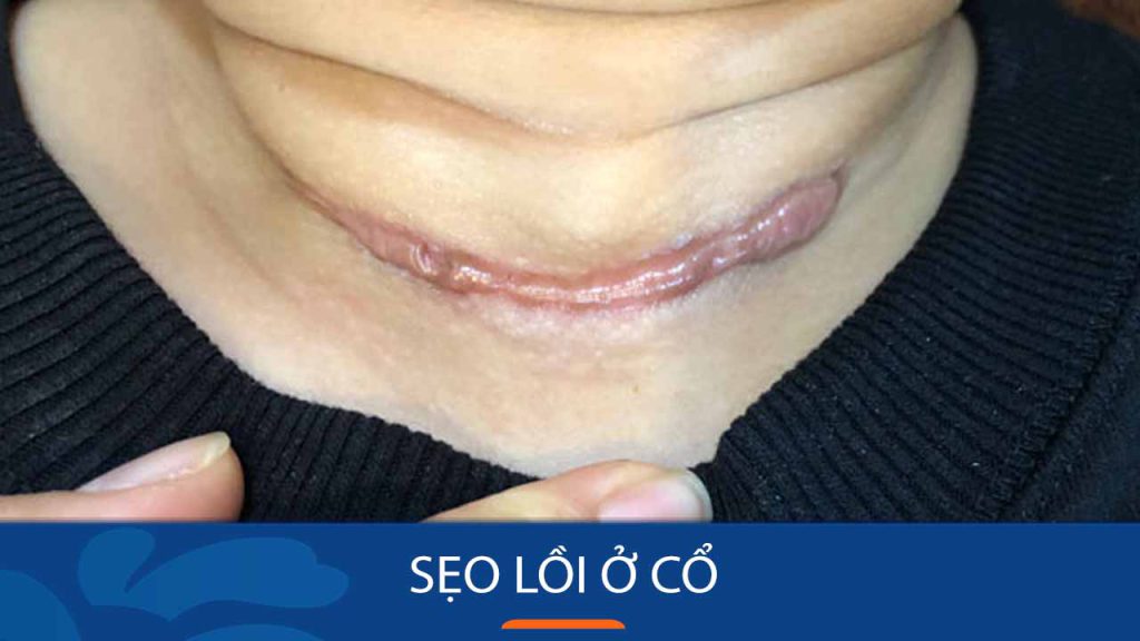 Sẹo lồi ở cổ: Nguyên nhân, cách điều trị và phòng ngừa