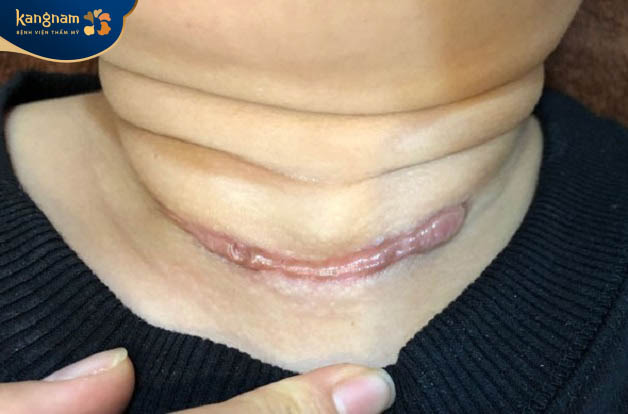 Sẹo lồi ở cổ là gì?