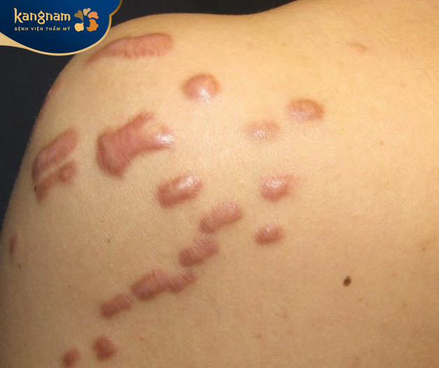 Sẹo lồi kích thước trung bình ở lưng