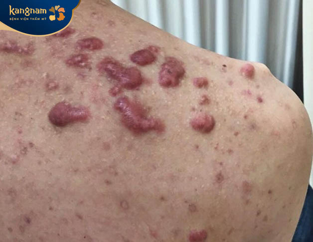 Giá tiền trị sẹo phụ thuộc nhiều vào cấp độ thẹo thực tế của khách hàng