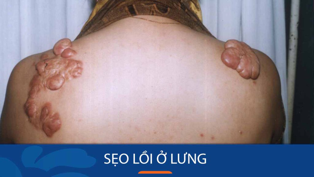 Sẹo lồi ở lưng: Nguyên nhân, triệu chứng và cách điều trị hiệu quả