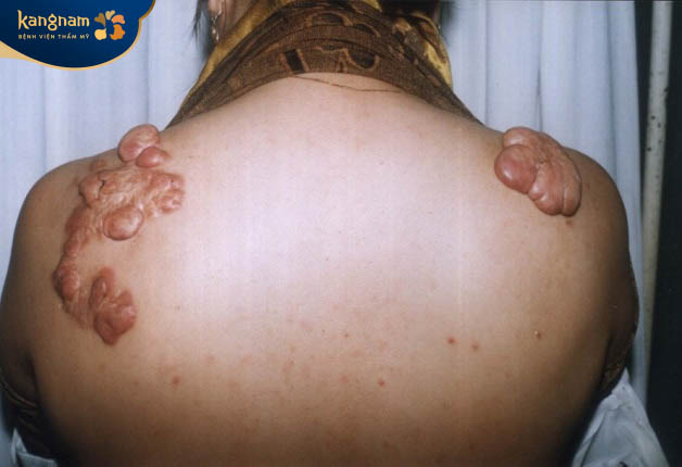 Sẹo lồi ở lưng là gì