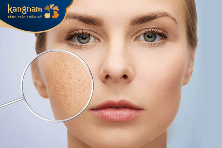 Trị sẹo rỗ thâm hiệu quả với những vết sẹo mới hình thành