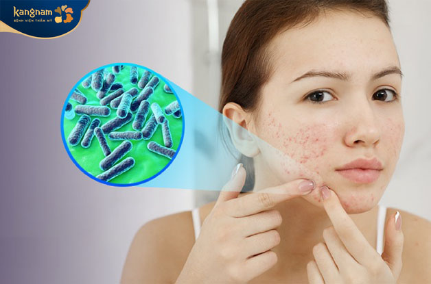 Mụn mọc nhiều trên da do nhiều nguyên nhân