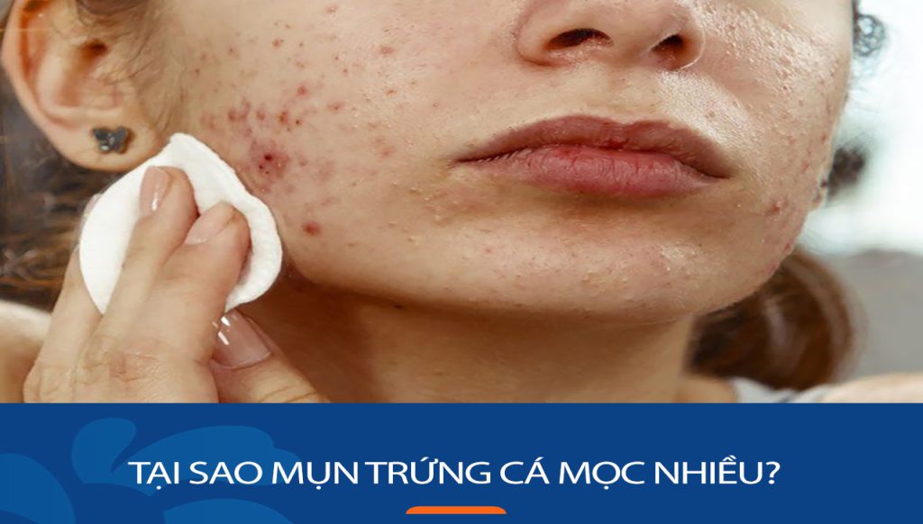Tại sao mụn trứng cá mọc nhiều: Giải mã nguyên nhân khiến da bạn mọc mụn trứng cá