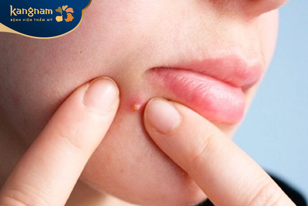Nặn mụn tăng nguy cơ nhiễm trùng