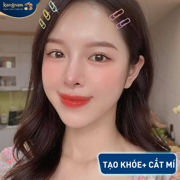 Tạo khóa, cắt mí giải quyết mọi khuyết điểm đôi mắt ủ rũ, nhiều da chùng