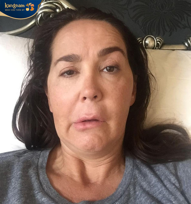 Liệt cơ mặt là một trong những biến chứng sau khi tiêm botox hỏng 