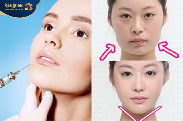Tiêm botox không thể duy trì được vĩnh viễn