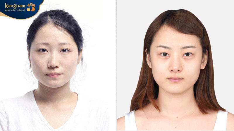 Cơ địa cũng ảnh hưởng đến thời gian duy trì