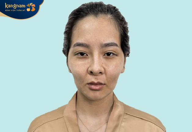 Tiêm filler làm đầy má phù hợp với người có gương mặt hốc hác