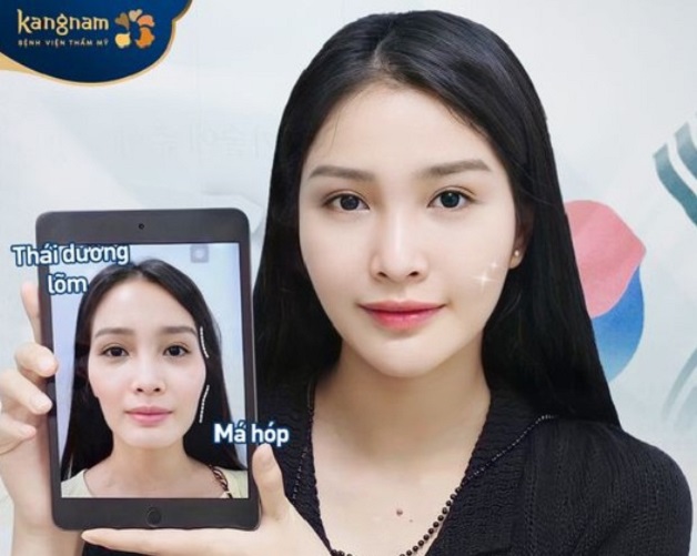 Tiêm filler má hóp có an toàn không?