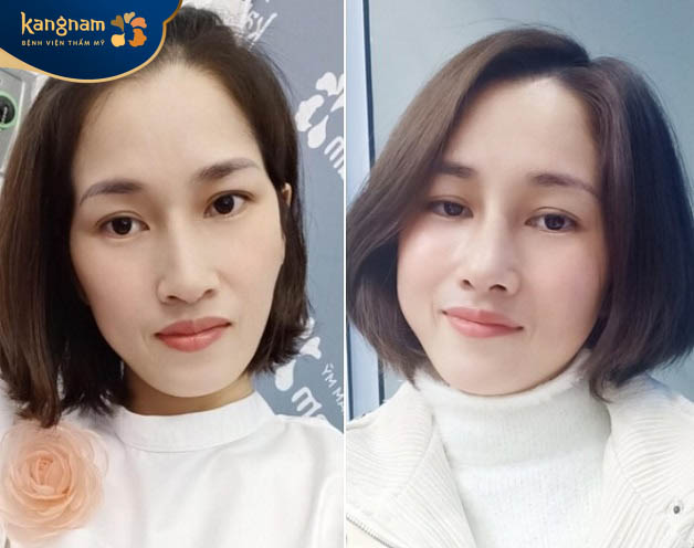 Chị Thanh Hà (31 tuổi, Hà Nội) chia sẻ sau tiêm filler làm đầy má bị hóp tại Kangnam
