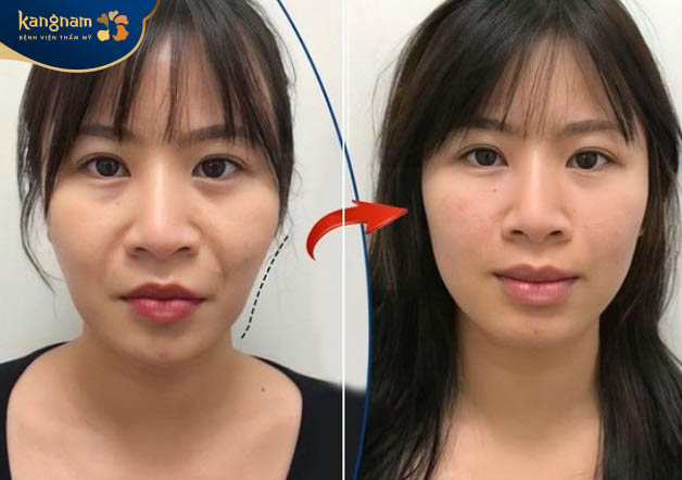 Chị Hương Trà (34 tuổi, Vĩnh Phúc) feedback về dịch vụ tiêm filler má
