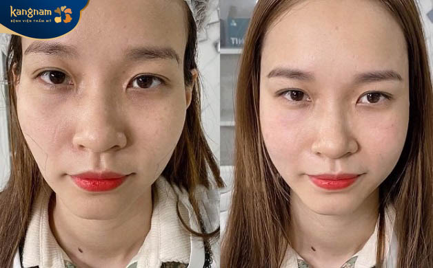 Chăm sóc sau tiêm filler má đúng cách để tăng hiệu quả thẩm mỹ