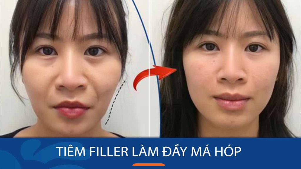 Tiêm filler má hóp: Bí quyết lấy lại gương mặt đầy đặn, trẻ trung
