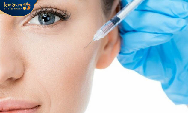 Tiêm filler làm đầy má