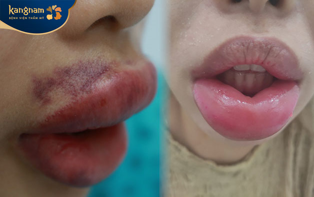 Tiêm chất làm đầy quá nhiều khiến môi sưng to 
